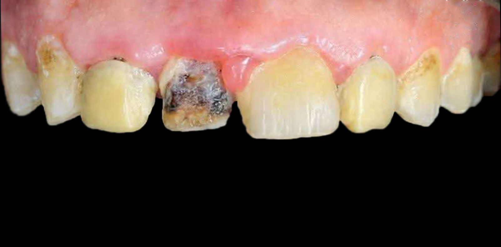قبل — تركيبات زيركون لتجميل الابتسامة في القصاصين